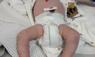 Врачи АОКБ избавили младенца от редкой патологии