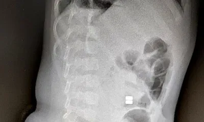 Магнитные шарики, проглоченные детьми, рушат их здоровье или приводят к смерти