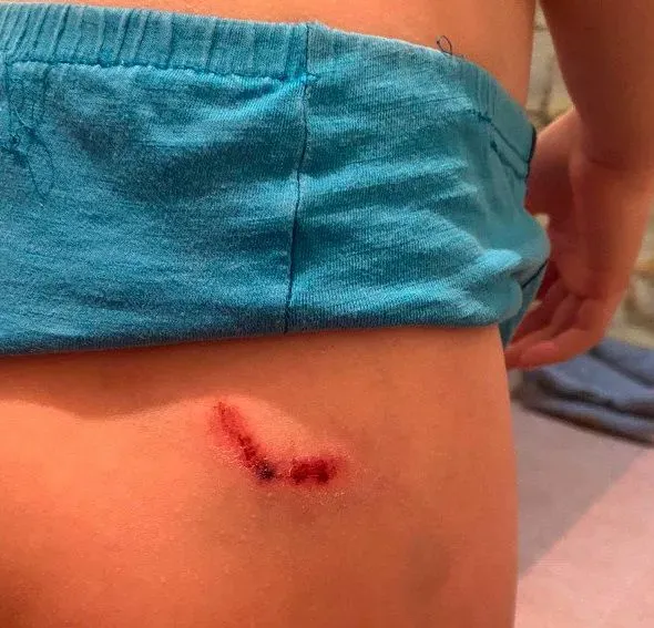 Собаки покусали двух детей в Тынде