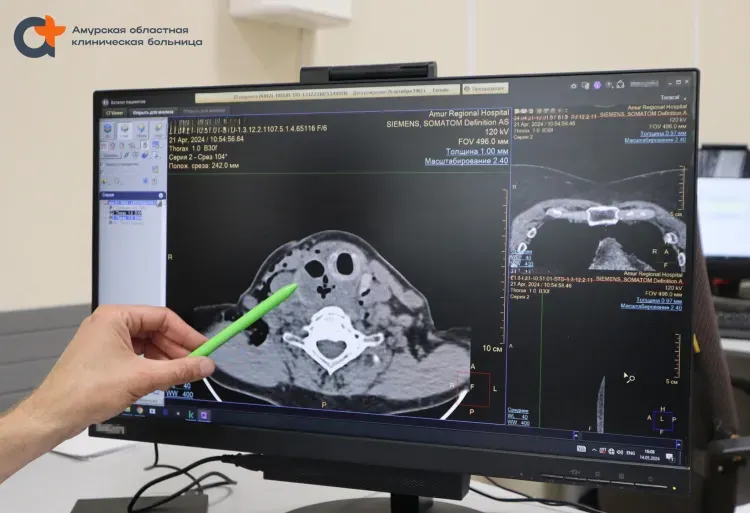 Рыбная кость могла загубить жизнь женщины